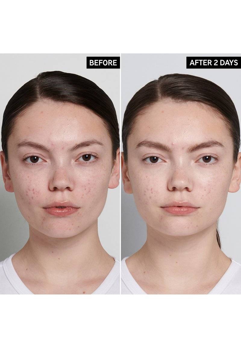 The INKEY List The INKEY List SUCCINIC ACID BLEMISH TREATMENT - Face cream - transparent Vierteljährliche Förderung
